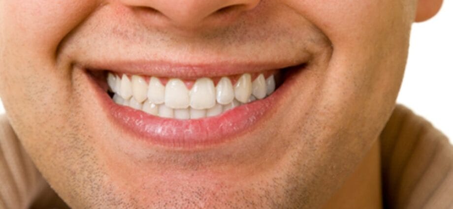 What to Expect After Getting Dental Veneers 1 What to Expect After Getting Dental Veneers - Newslibre